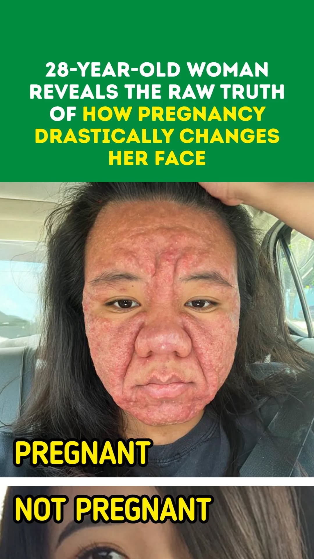 28-Year-Old Woman Reveals the Raw Truth of How Pregnancy Drastically Changes Her Face